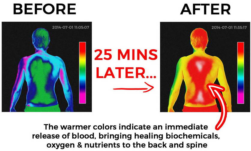 backpain thermal before after